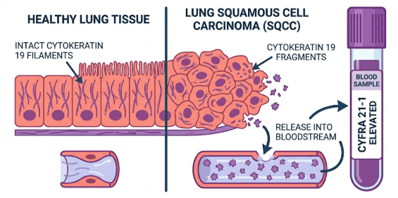 medical illustration showing a cross-section of lung tissue.